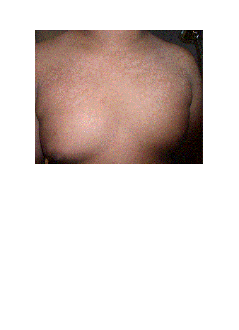 image for page Bệnh lang ben