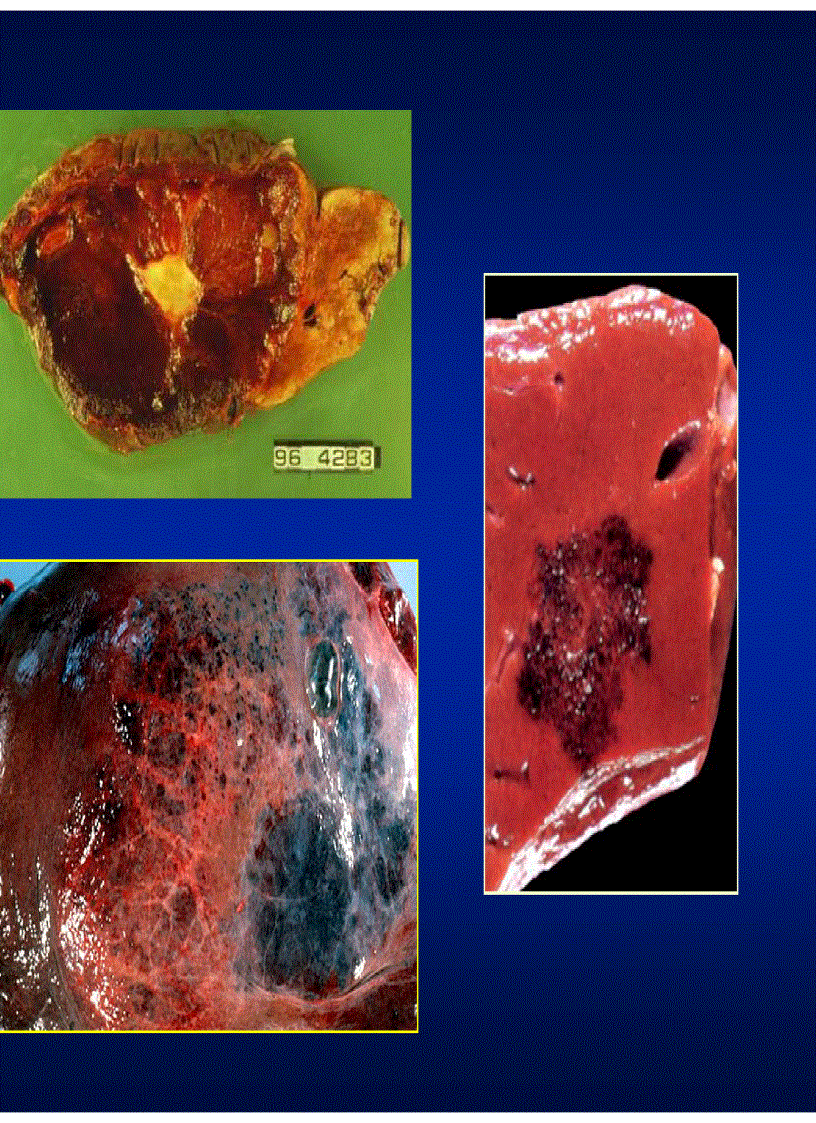 image for page Chẩn đoán hình ảnh u gan