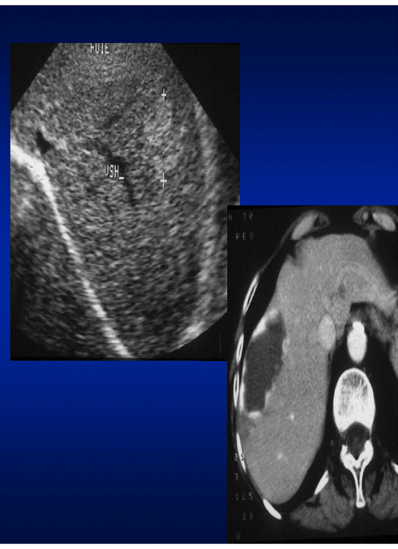 image for page Chẩn đoán hình ảnh u gan