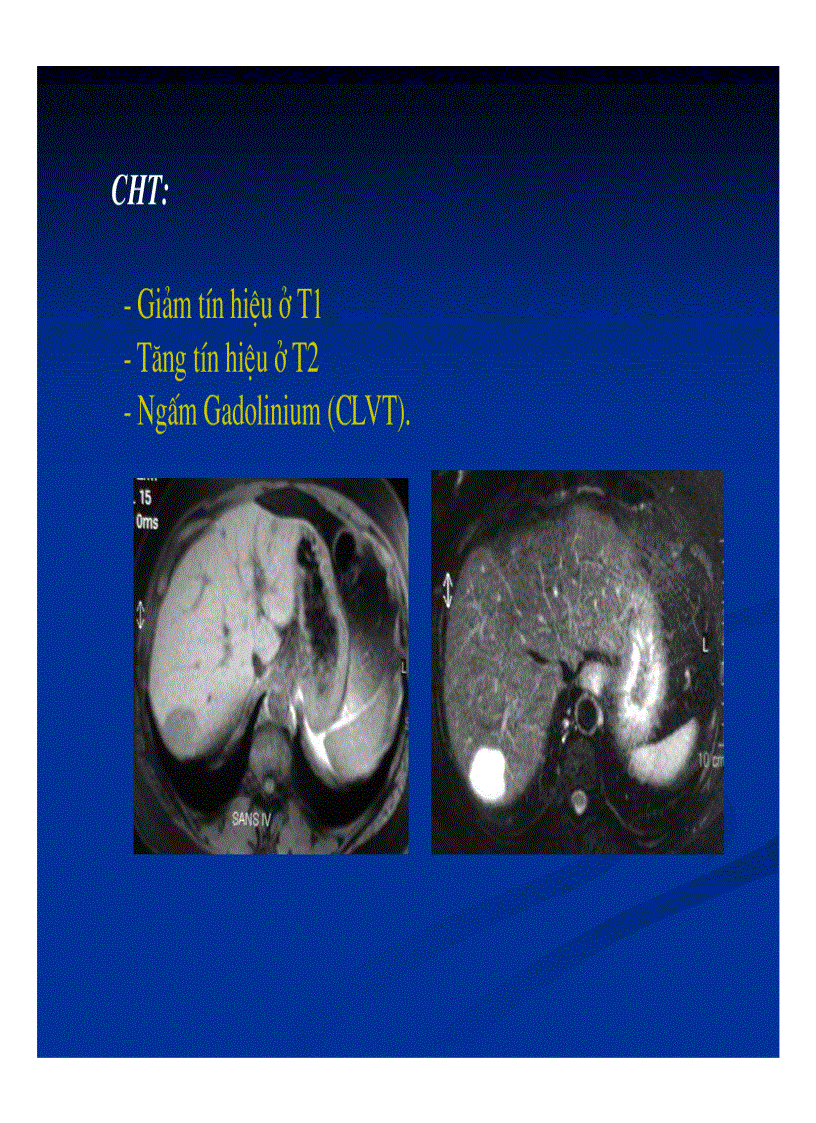 image for page Chẩn đoán hình ảnh gan mật