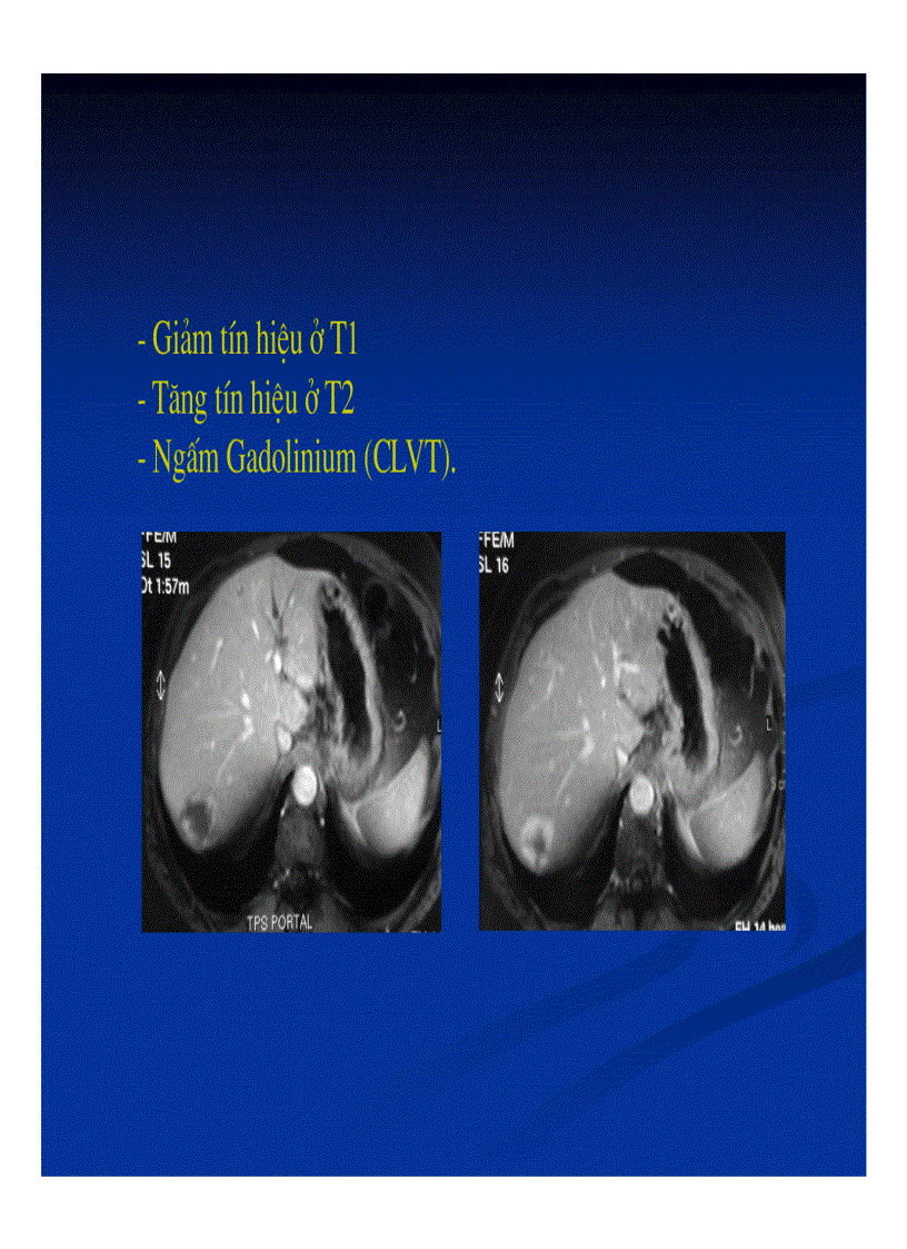image for page Chẩn đoán hình ảnh gan mật