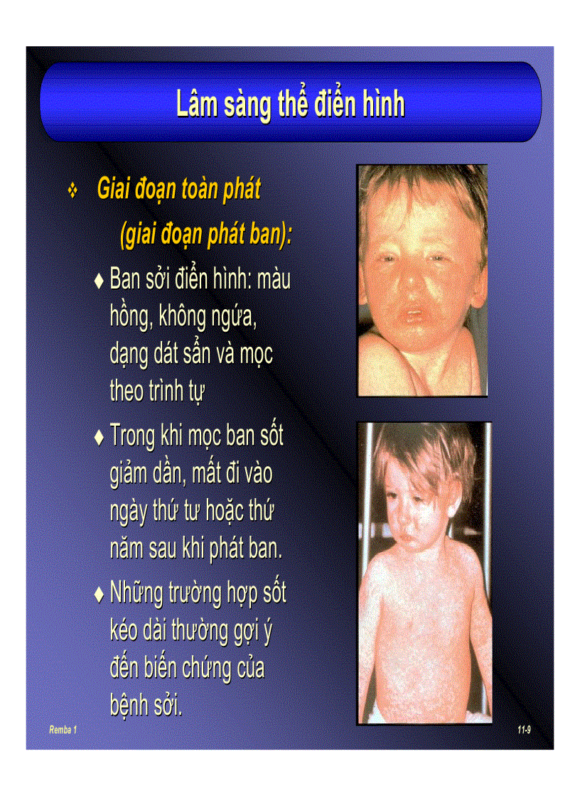 image for page Bệnh sởi