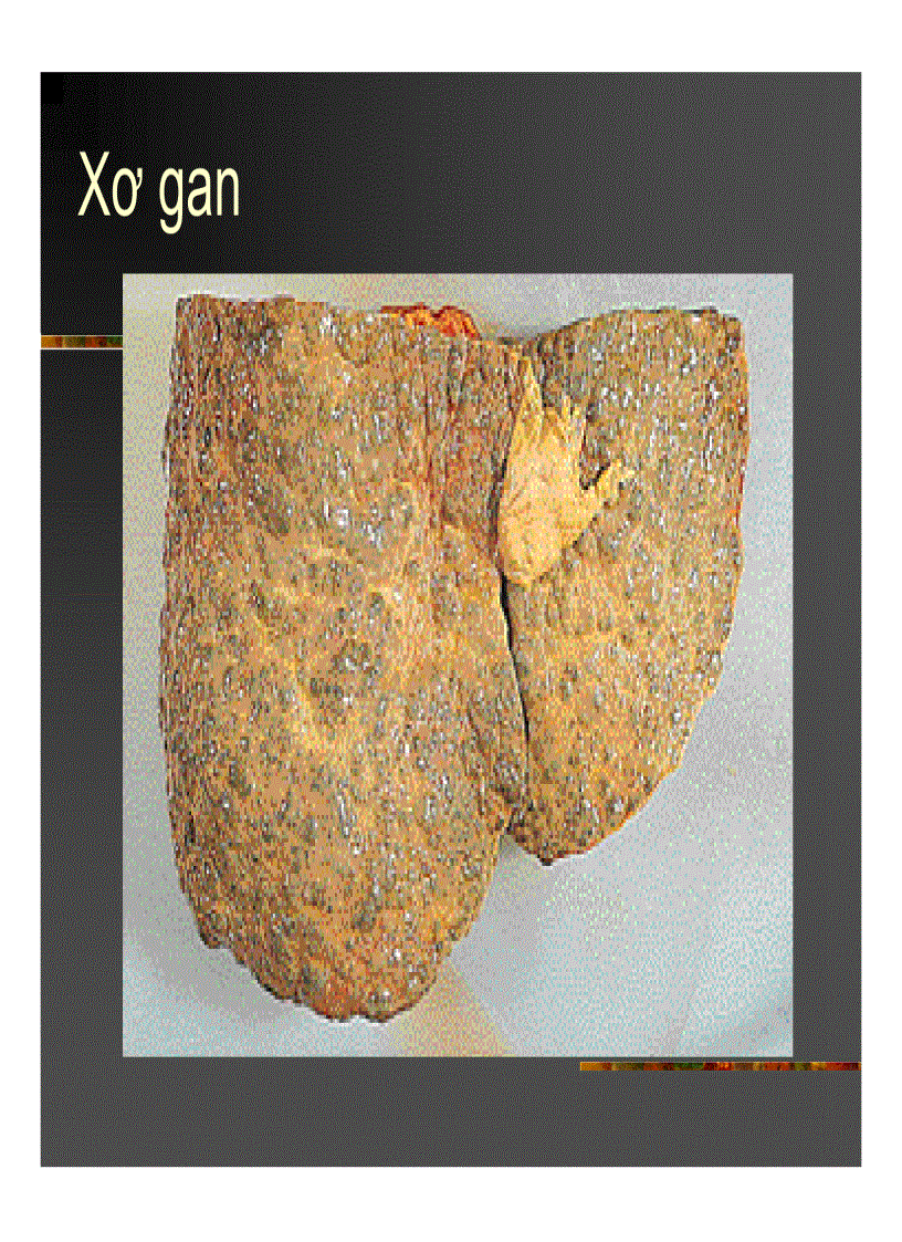 image for page Xơ gan Ung thư gan