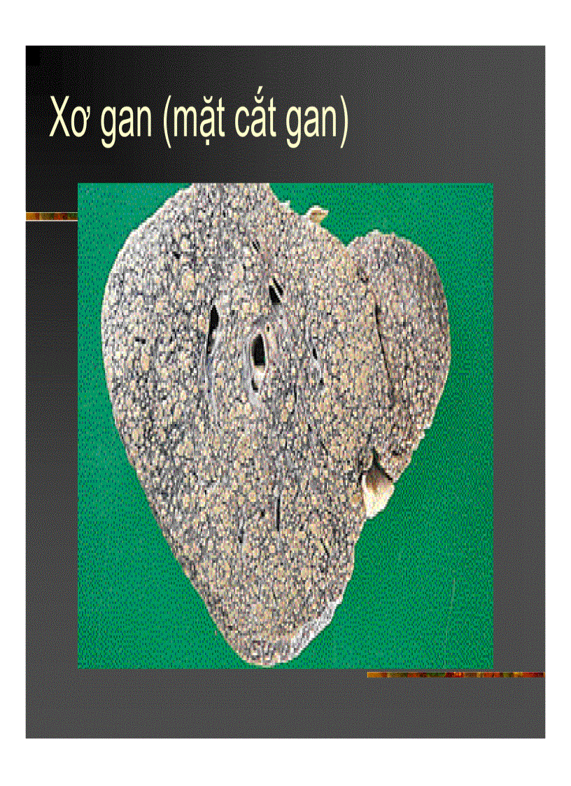 image for page Xơ gan Ung thư gan