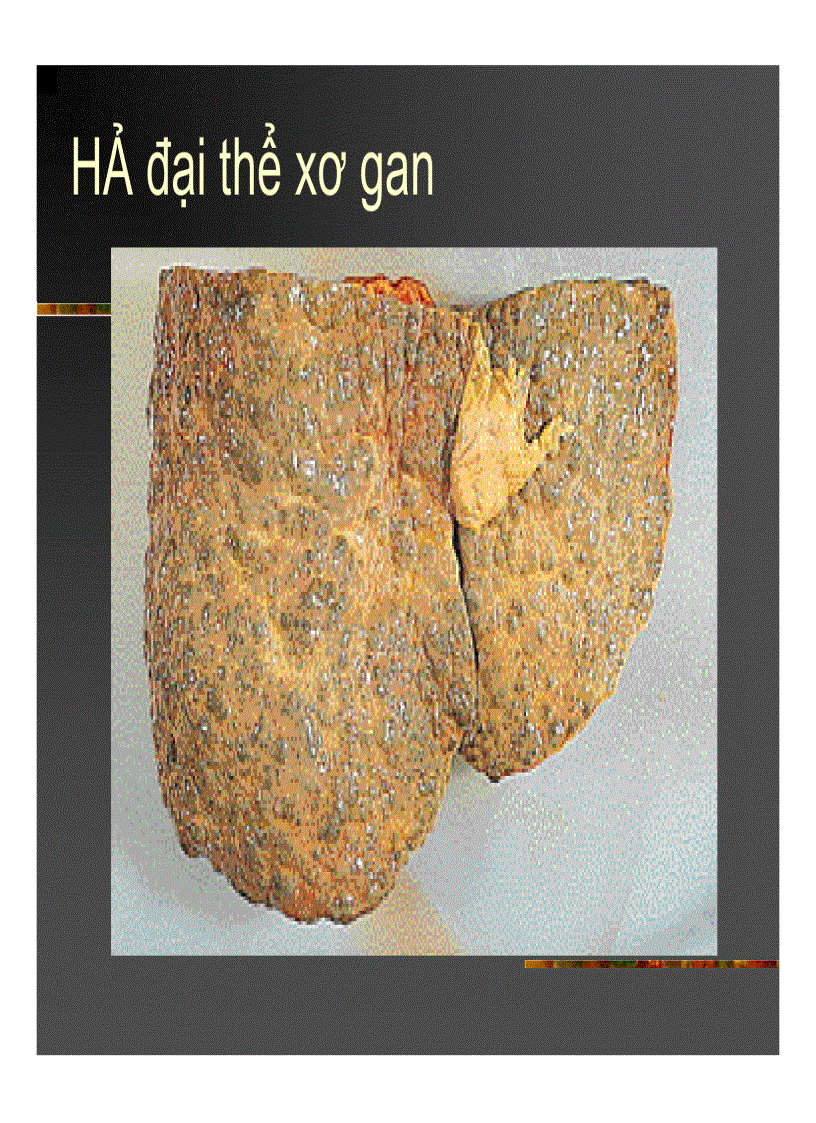image for page Xơ gan Ung thư gan