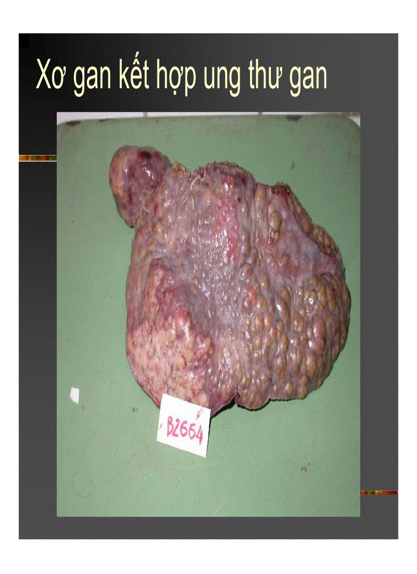 image for page Xơ gan Ung thư gan