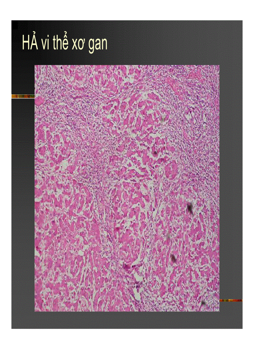 image for page Xơ gan Ung thư gan