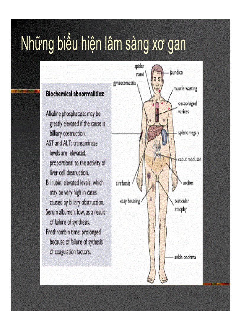 image for page Xơ gan Ung thư gan