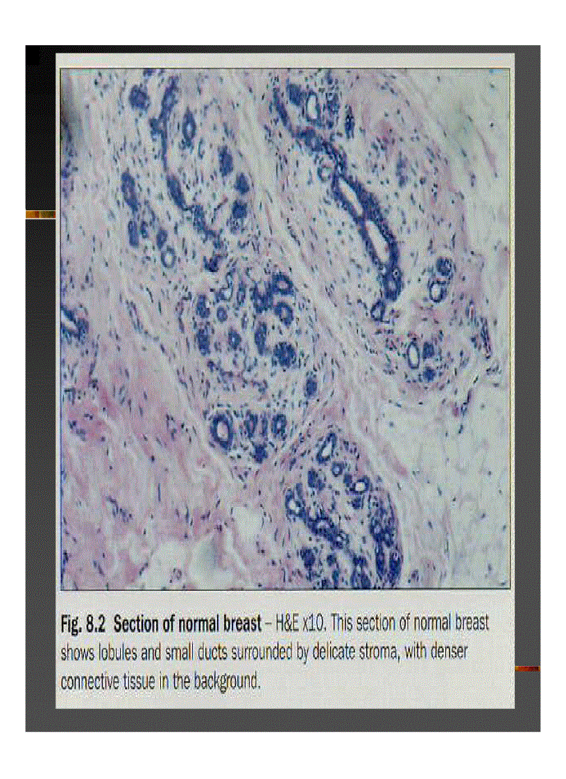 image for page GIẢI PHẪU Bệnh tuyến vú