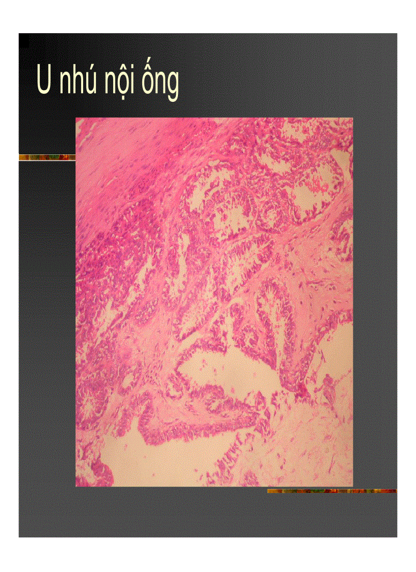 image for page GIẢI PHẪU Bệnh tuyến vú