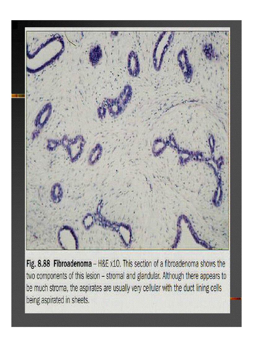 image for page GIẢI PHẪU Bệnh tuyến vú