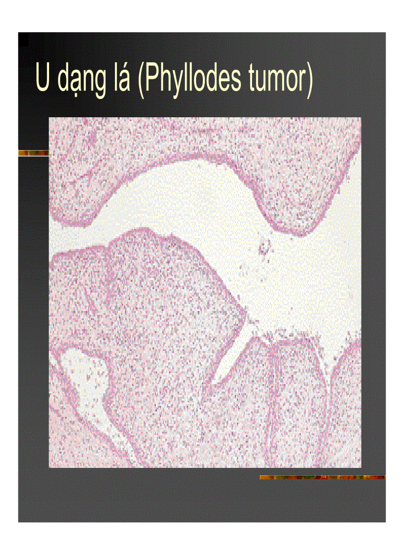 image for page GIẢI PHẪU Bệnh tuyến vú