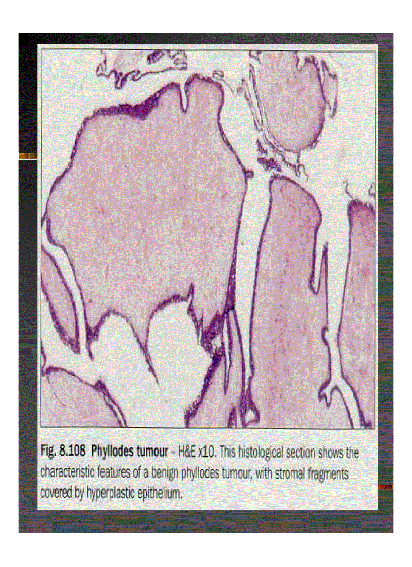 image for page GIẢI PHẪU Bệnh tuyến vú