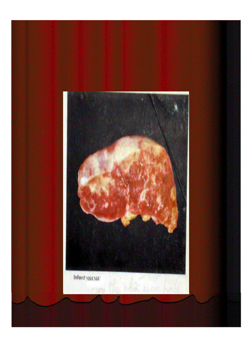 image for page Giải phẫu Tắc mạch