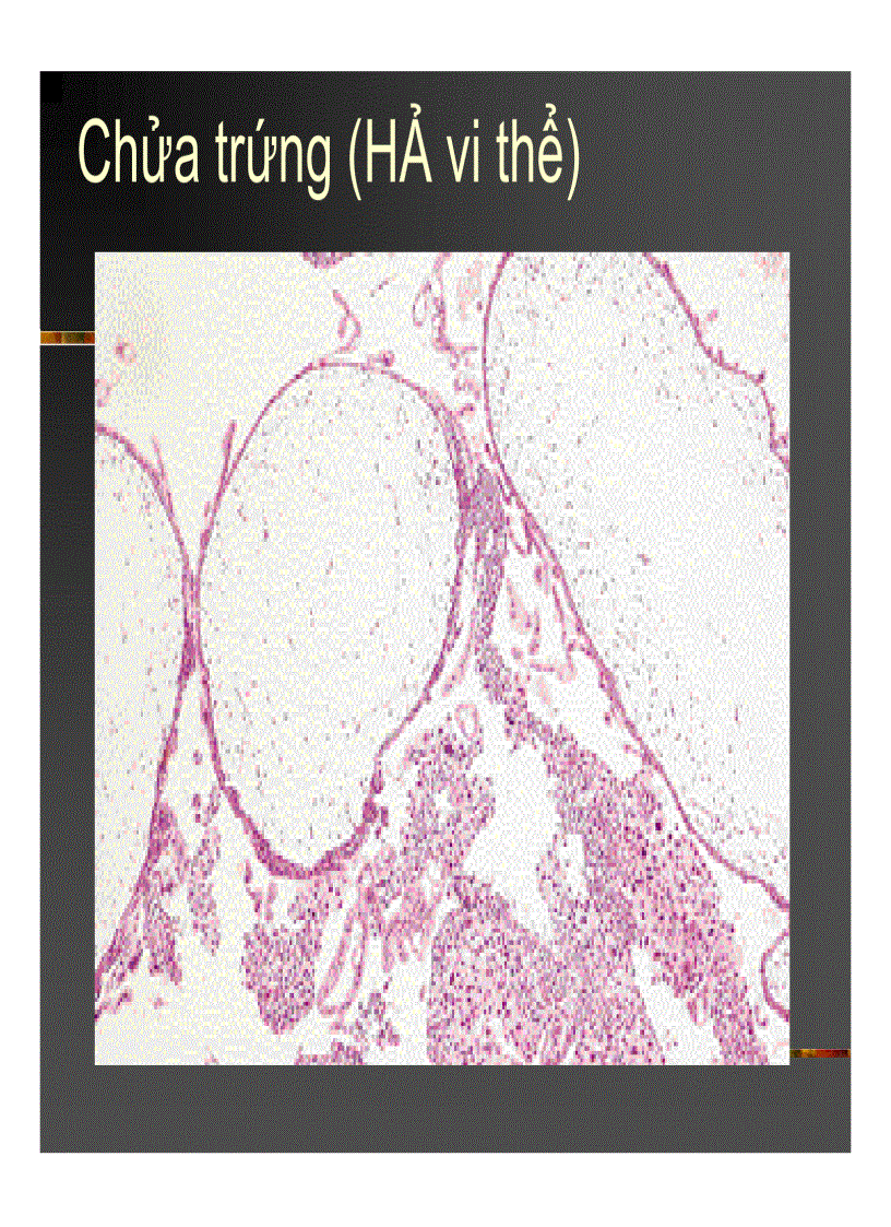 image for page Giải phẫu bệnh Chửa trứng Ung thư biểu mô rau