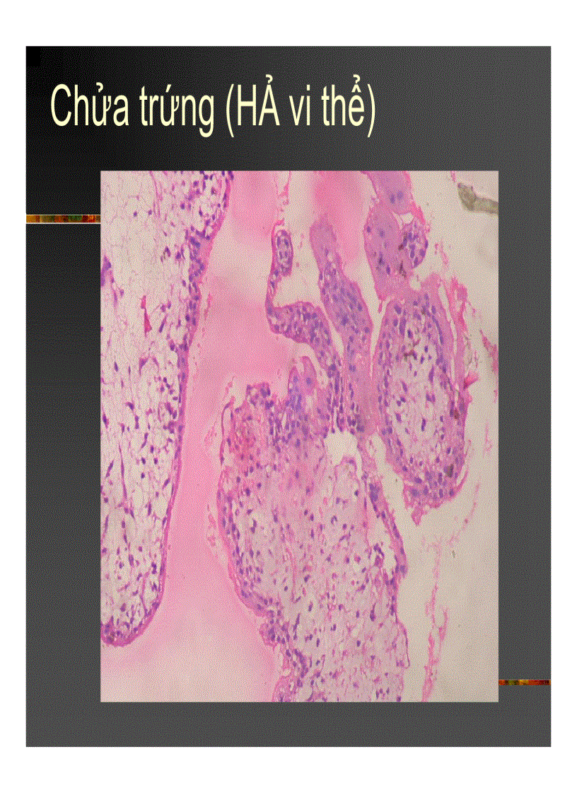 image for page Giải phẫu bệnh Chửa trứng Ung thư biểu mô rau