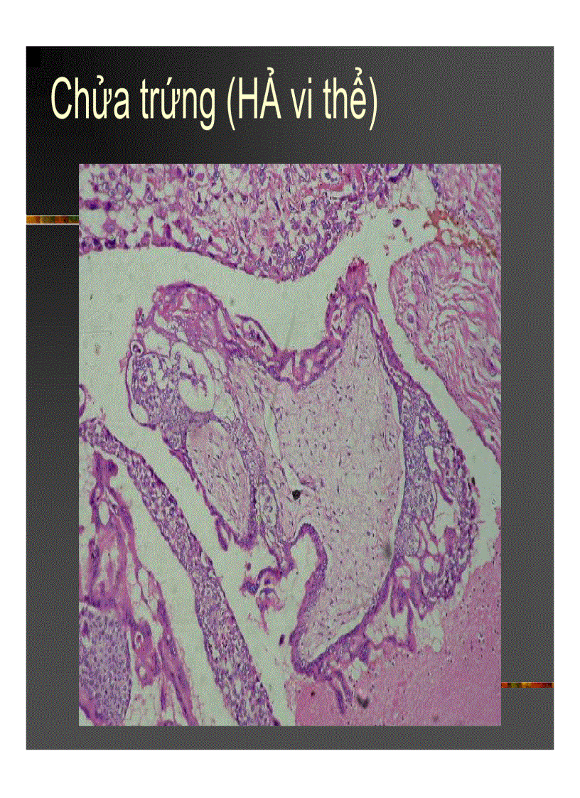 image for page Giải phẫu bệnh Chửa trứng Ung thư biểu mô rau