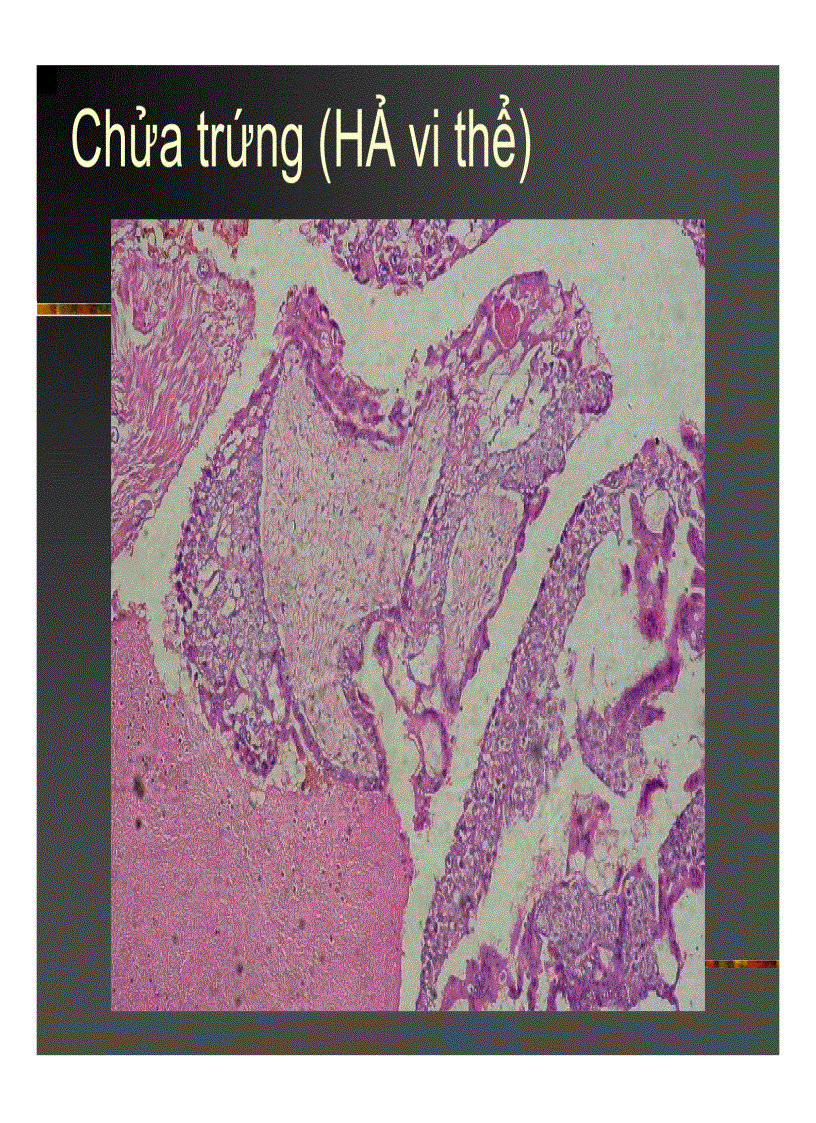 image for page Giải phẫu bệnh Chửa trứng Ung thư biểu mô rau