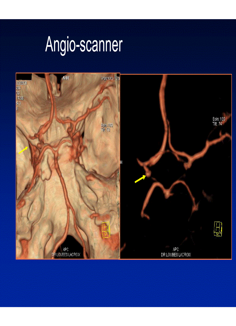 image for page Chảy máu não