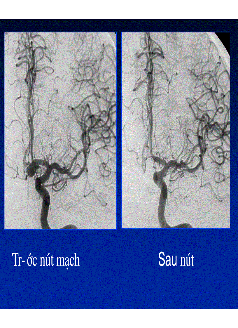 image for page Chảy máu não