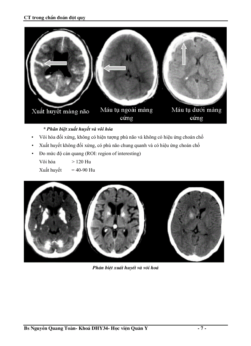 image for page Ct trong chẩn đoán đột quỵ não