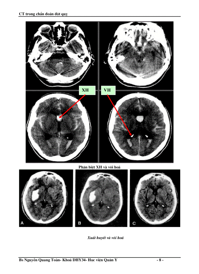 image for page Ct trong chẩn đoán đột quỵ não