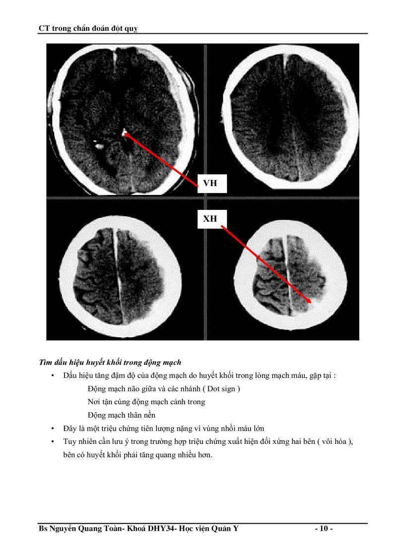 image for page Ct trong chẩn đoán đột quỵ não