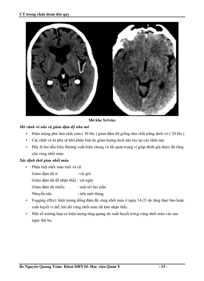 image for page Ct trong chẩn đoán đột quỵ não