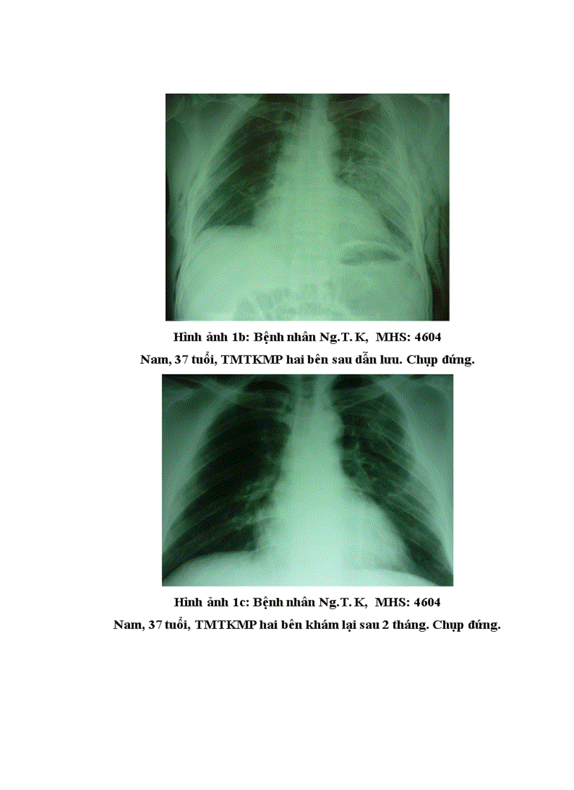 image for page Nghiên cứu đặc điểm lâm sàng cận lâm sàng và kết quả điều trị tràn máu tràn khí màng phổi hai bên trong chấn thương ngực kín