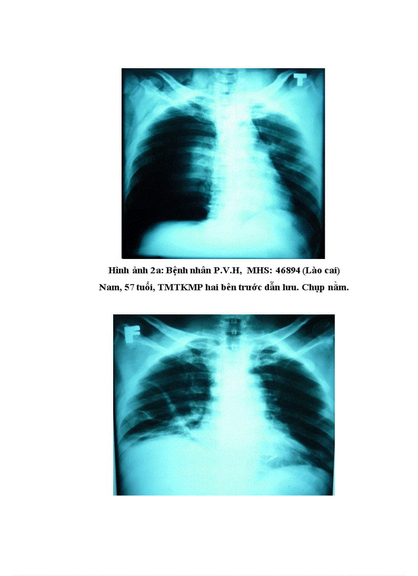 image for page Nghiên cứu đặc điểm lâm sàng cận lâm sàng và kết quả điều trị tràn máu tràn khí màng phổi hai bên trong chấn thương ngực kín