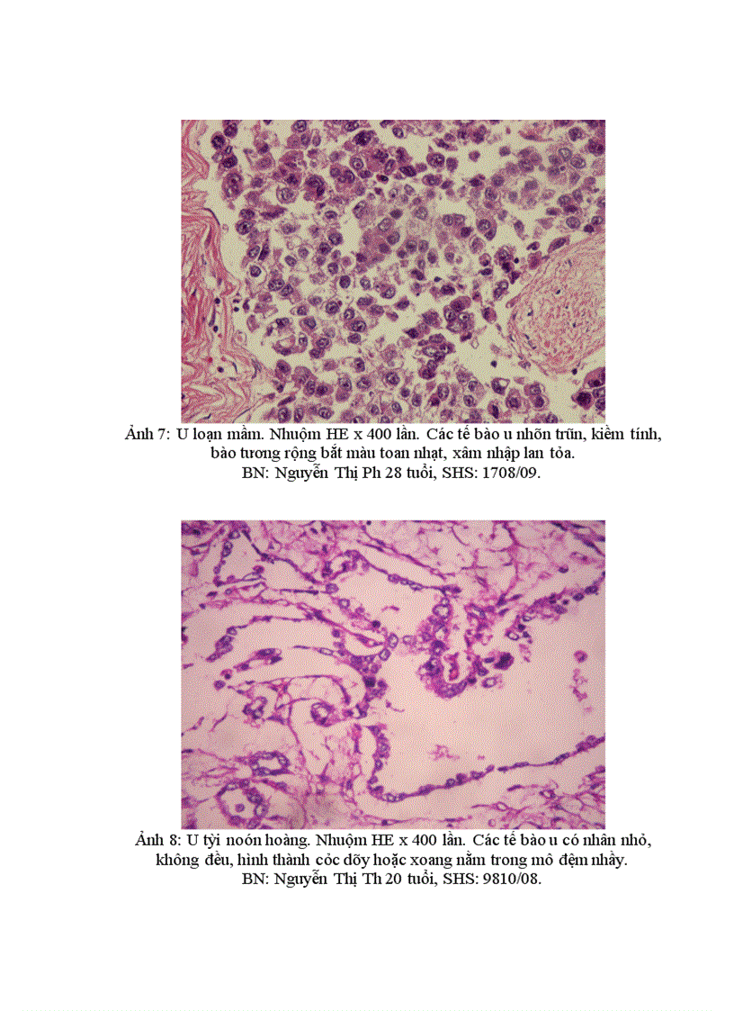 image for page Nhận xét đặc điểm lâm sàng cận lâm sàng và giá trị sinh thiết tức thì trong chẩn đoán u buồng trứng tại Bệnh viện K