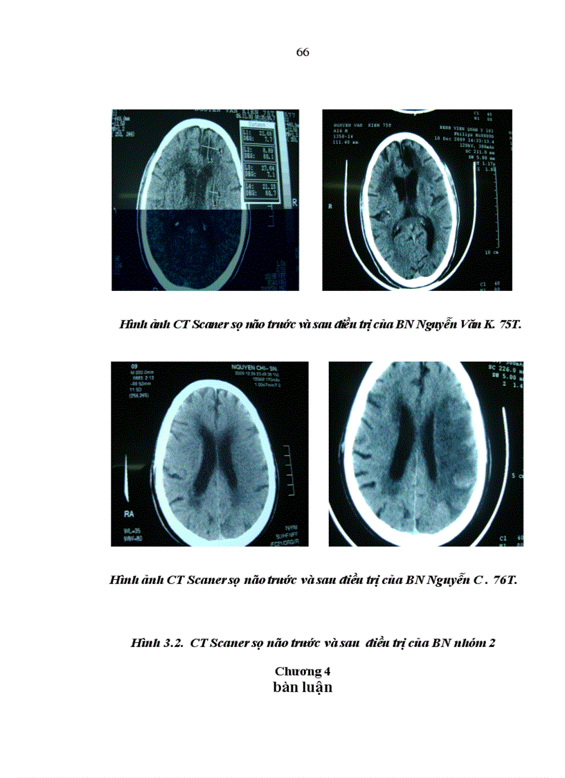 image for page Nghiên cứu điều trị Đột quỵ nhồi máu não giai đoạn cấp của thuốc AN CUNG NGƯU HOàng hoàn acnhh