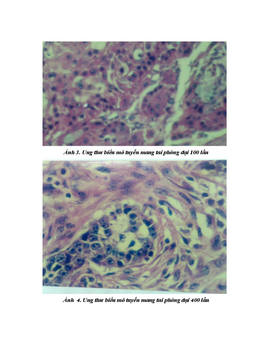 image for page Nhận xét đặc điểm lâm sàng cận lâm sàng và kết quả điều trị của ung thư tuyến mang tai tại bệnh viên k từ năm 2005 đến 2009