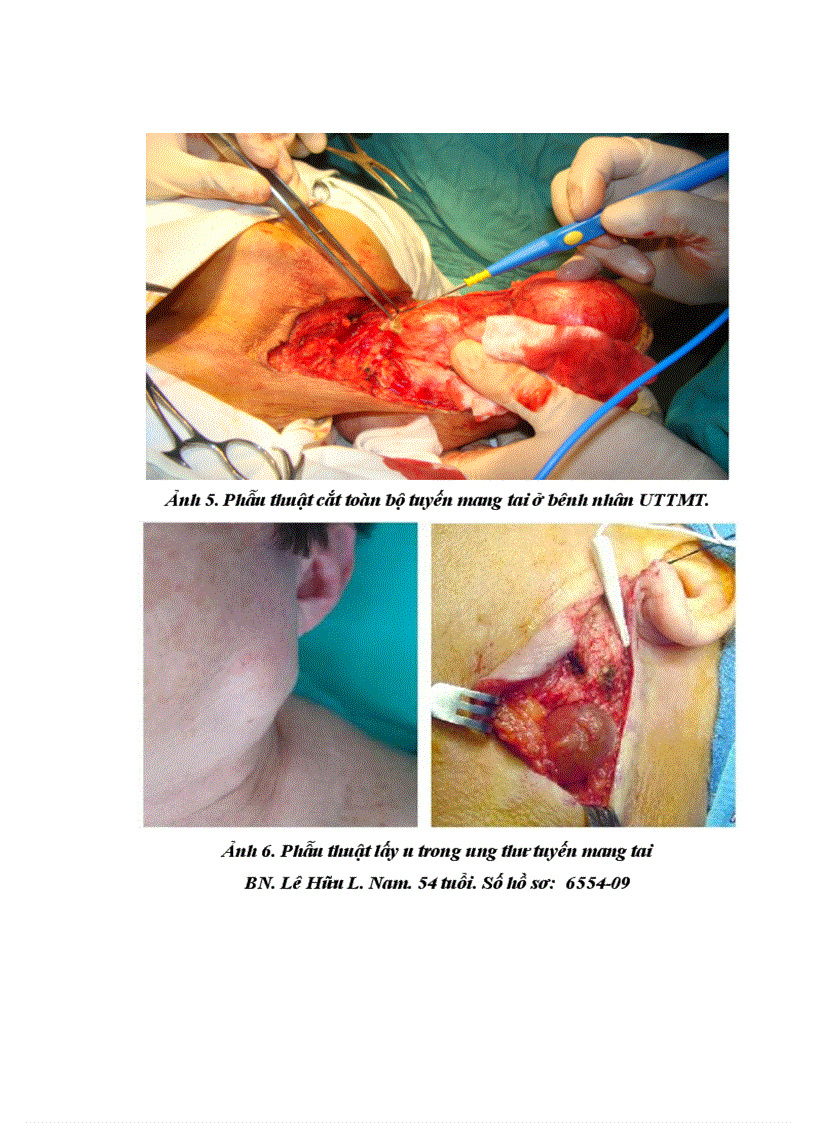 image for page Nhận xét đặc điểm lâm sàng cận lâm sàng và kết quả điều trị của ung thư tuyến mang tai tại bệnh viên k từ năm 2005 đến 2009