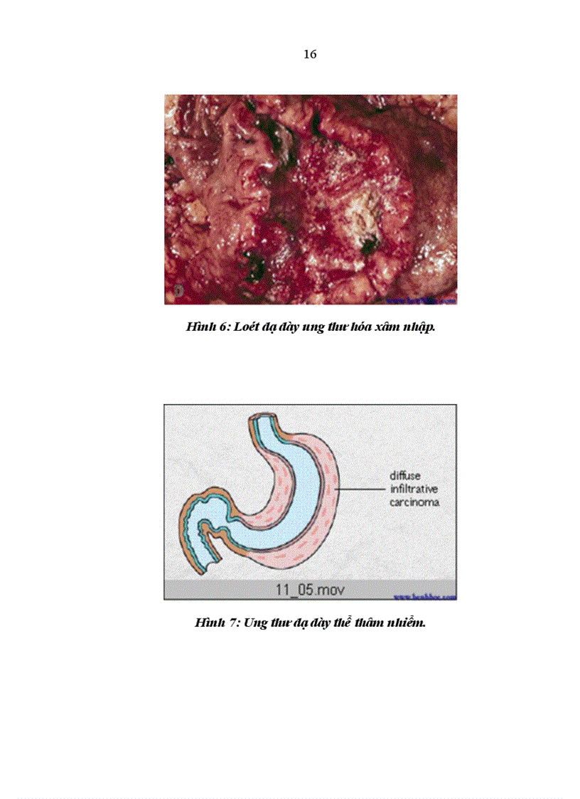 image for page Nghiên cứu triệu chứng lâm sàng cận lâm sàng ở bệnh nhân cắt toàn bộ dạ dày nạo vét hạch ở bệnh viện Việt Đức từ năm 2006 tới 201