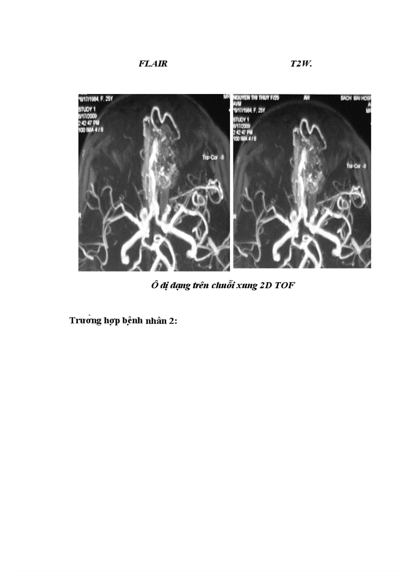 image for page Nghiên cứu đặc điểm hình ảnh và giá trị của chụp cộng hưởng từ trong đánh giá tổn thương dị dạng động tĩnh mạch não