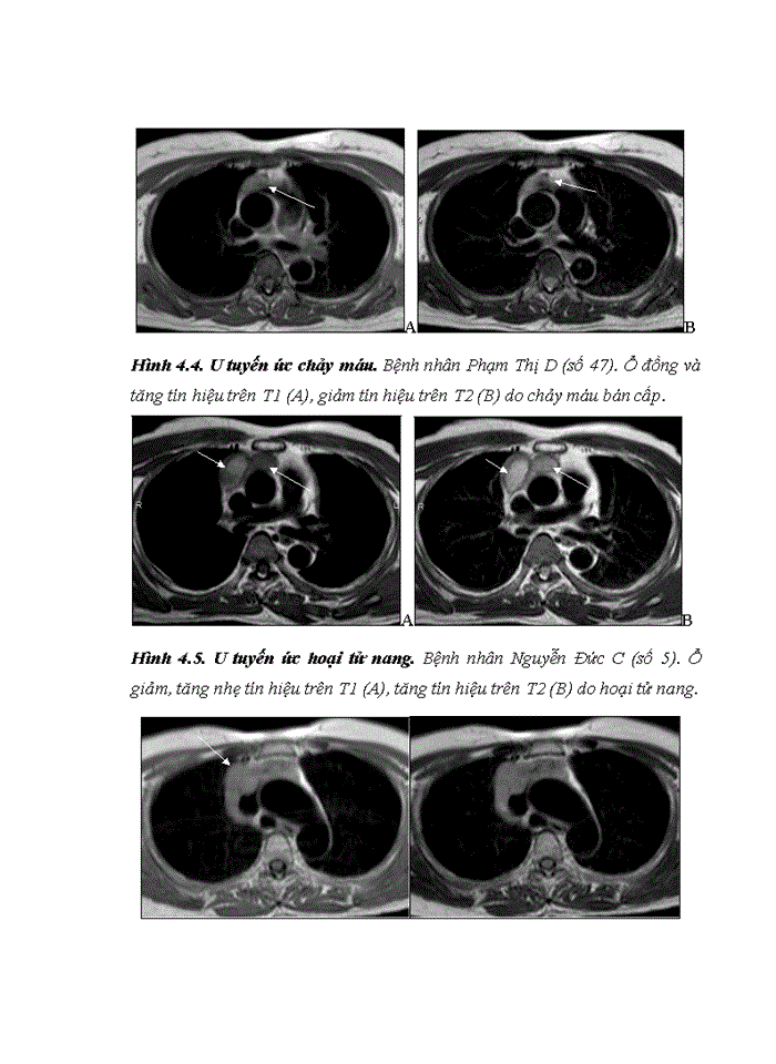 image for page NGHIÊN CỨU ĐẶC ĐIỂM HÌNH ẢNH VÀ GIÁ TRỊ CỦA CỘNG HƯỞNG TỪ TRONG ĐÁNH GIÁ TỔN THƯƠNG TUYẾN ỨC Ở BỆNH NHÂN NHƯỢC CƠ